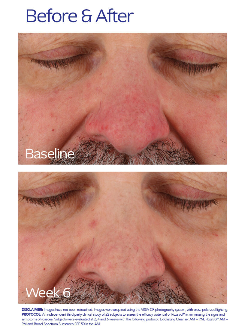 ゼオスキンヘルス　ロザトロール Rozatrol | Redness & Rosacea Serum | ZO Skin Health, Inc.